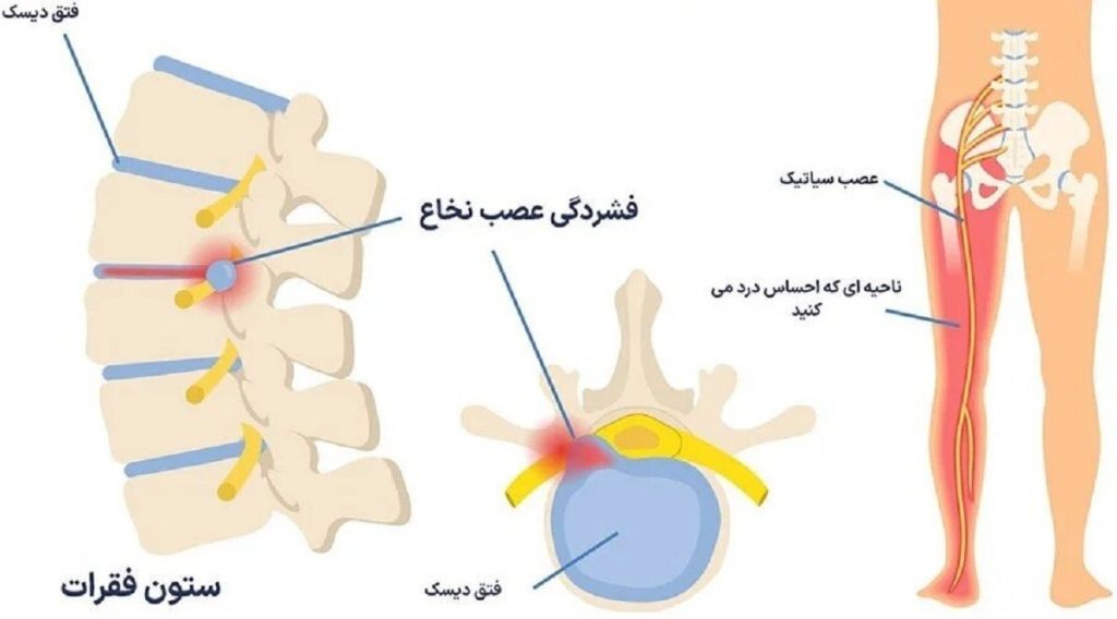 دیسک کمر چیست و چه علائمی دارد